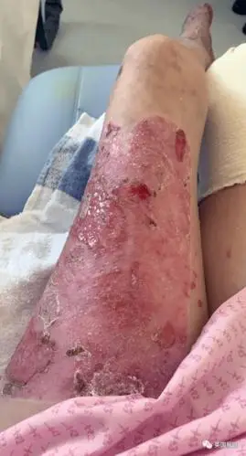 可怕英国25岁女子泡澡后被截肢医生再晚点命都没了