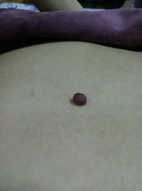 胸口有个红色的痣,黄豆大小.不痛不痒.请问是什么痣?