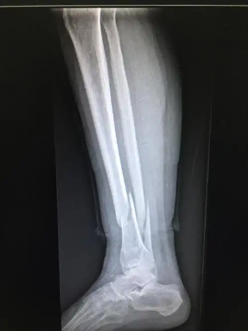 百年李氏骨伤技术结合现代微创理念在下肢骨折的应用