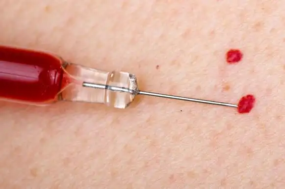 红色,血管瘤,毛细血管,肚子,婴儿正版图片素材下载