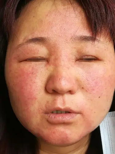 季节性接触性皮炎