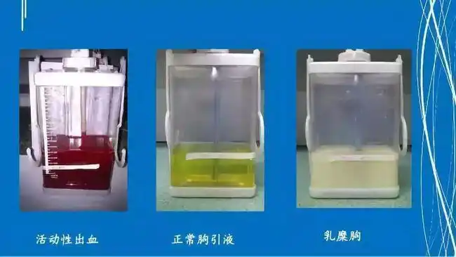 为健康加分肺癌术后科普胸腔积液的那些事