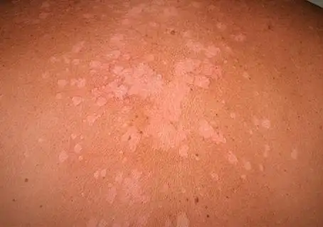 汗癣长什么样子