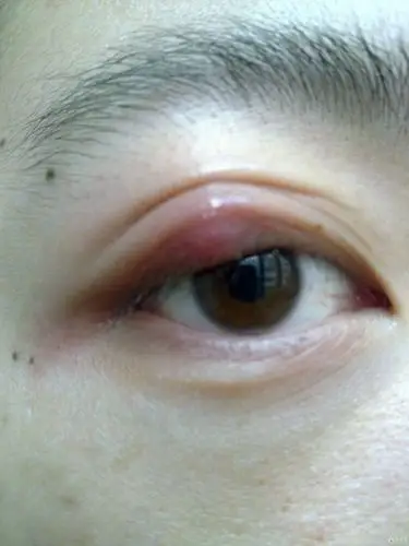 霰粒肿求证?该如何处理?