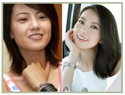 整牙=换脸?细数大众关于矫正疑问大盘点