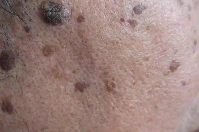 扁平疣与老年斑的区别图片_图文_文章_美咯_让您放心美!