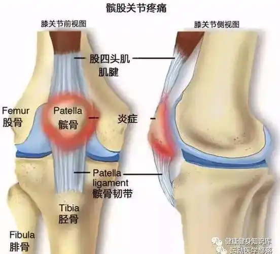 膝前痛是第二大常见的膝关节疼痛部位.