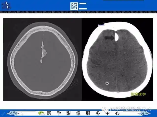 易误诊为出血的大脑镰钙化,你会看吗?