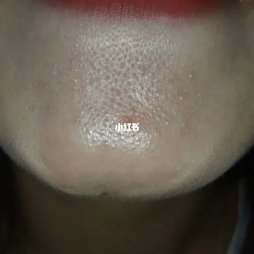 打卡‖刷酸去闭口去黑头の预备篇_刷酸_闭合性粉刺_黑头_去闭口_去