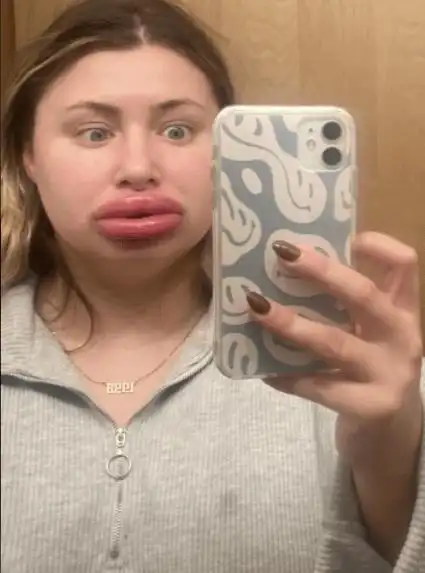 肿成8倍大"香肠嘴","超惨烈"模样曝光_琼思_嘴唇_kailee