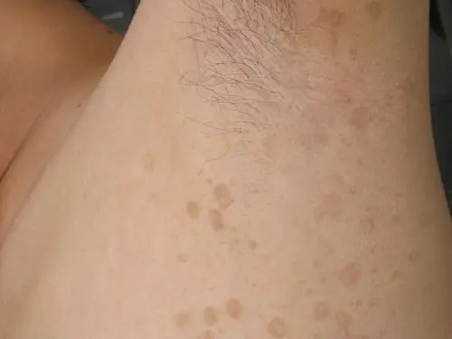 怎么做可以预防花斑癣出现