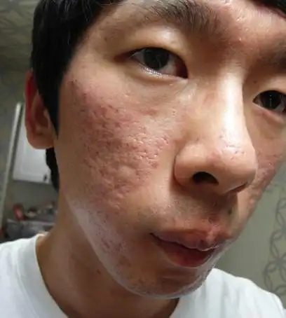 去美容院去挑痘会使皮肤毛孔粗大吗?