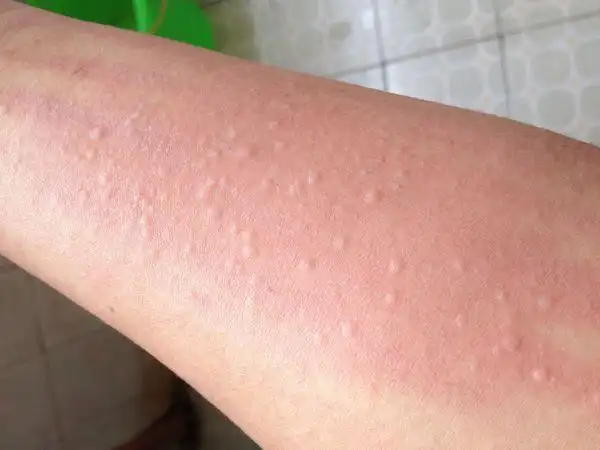 身上很痒一抓起红点是怎么回事