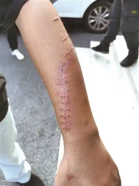 小王手臂上的伤痕触目惊心. 今报记者 钟华 摄