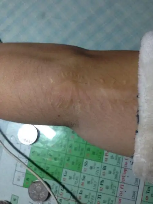 这个疤痕民航招飞能过吗?