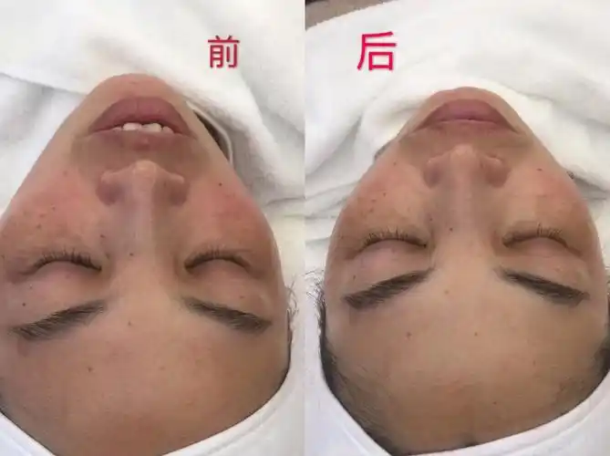 韩国小气泡深层清洁前后对比图「第一次」