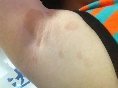 腋窝下有深褐色圆形斑点是怎么回事