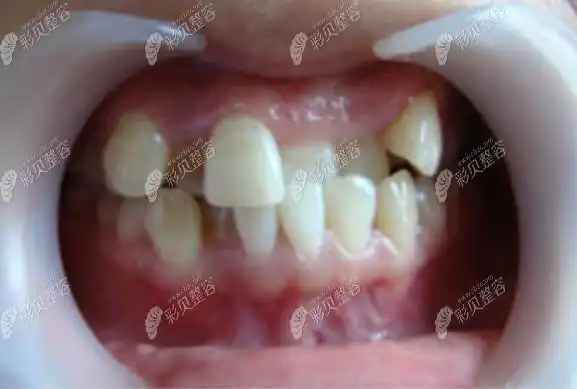 22岁在宜昌中汉口腔做牙齿咬合错位矫正后的对比图片及过程