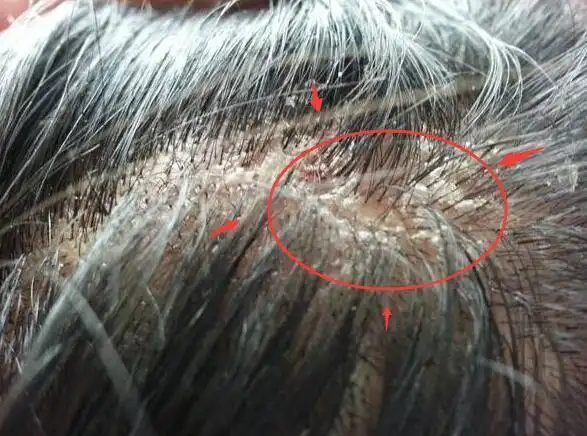 有人说头皮屑渗液结痂放两片阿司匹林能解决想多了