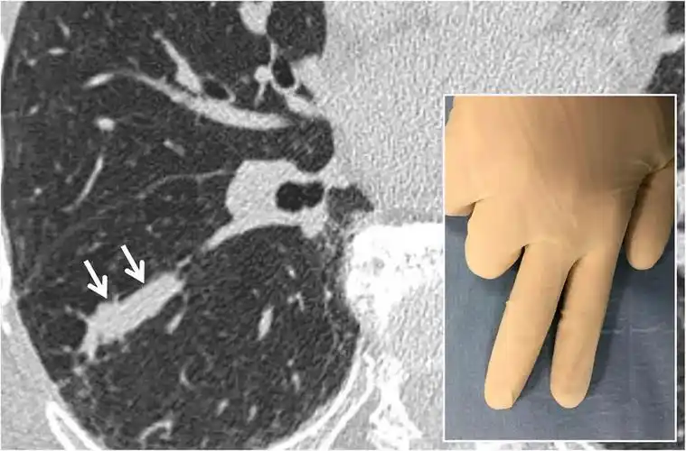 18种胸部ct征象你见过多少上│以影识病