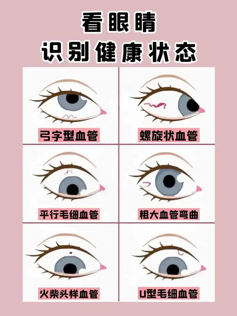 中医教你看眼睛,6种眼睛状况,识别健康状态! 1,粗大血管弯 - 抖音