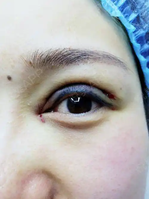 眼部多项手术当天_开内眼角手术当天_全切双眼皮手术当天_眼部多项