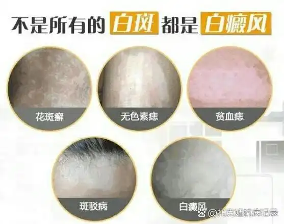 4种白斑容易与白癜风混淆,今日教你区别,做好笔记!