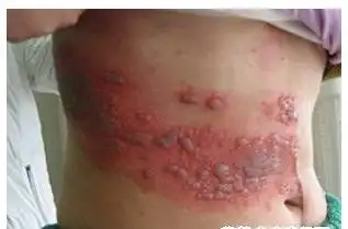 艾滋病疱疹症状