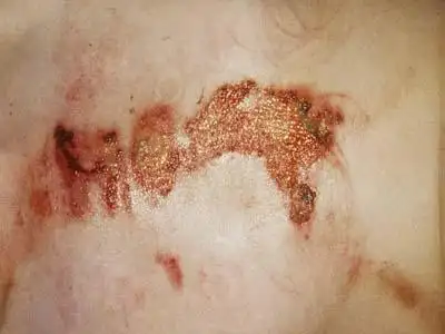 硝酸灼伤皮肤会留疤吗