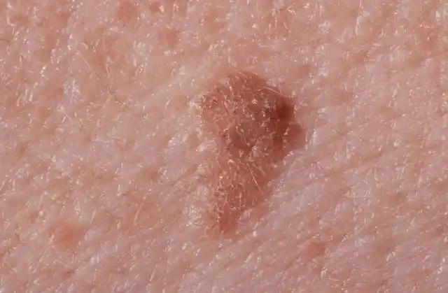 妇科主任提醒大家,当女性朋友发现了自己私密部位长了"红色的小疙瘩"