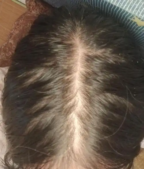 求助看了医生脂溢性脱发感觉人生没有希望了