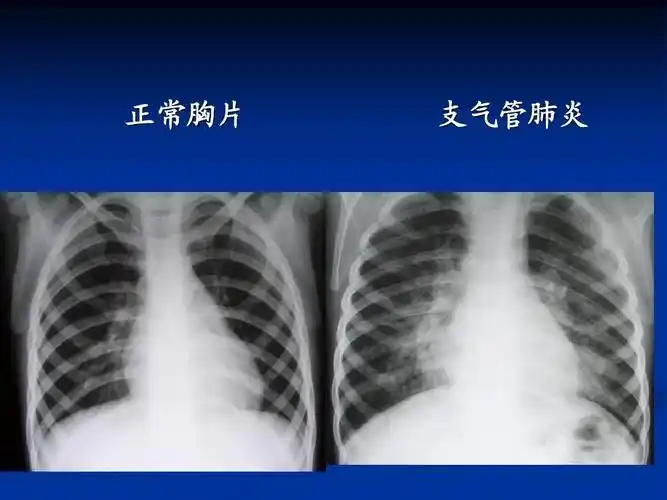 中医儿科学课件资料 正常胸片 支气管肺炎