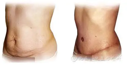 腹壁整形效果对比图