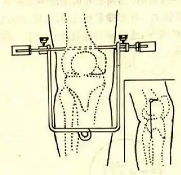 图解骨科牵引的常用方式及技巧_股骨