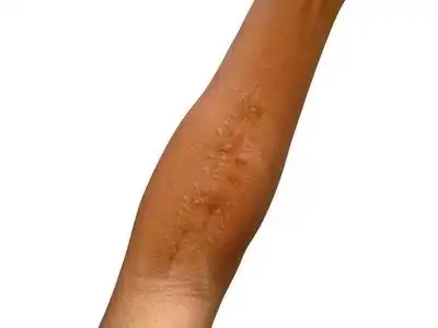 医院 激光 纹理 男人 健康 伤痕累累 人类 照顾 真皮照片