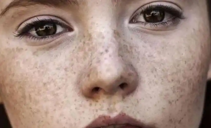 黑色素沉淀怎么去除最简单的办法