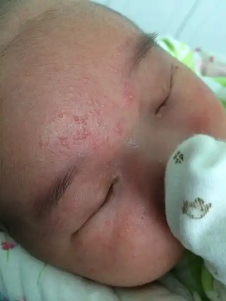 宝宝21天了脸上突然长了不知道是脂肪粒还是热疹,请各位帮帮忙谢谢了