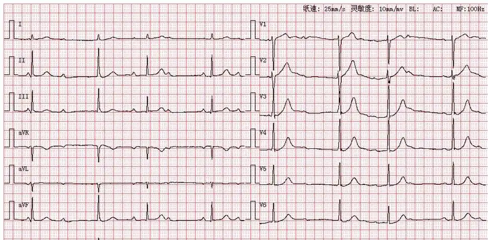 每日读图 || 第1099期 心梗 wpw