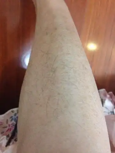 本人小腿出现这种状况大概有一年了,无意看见网上图片叫鱼鳞病?