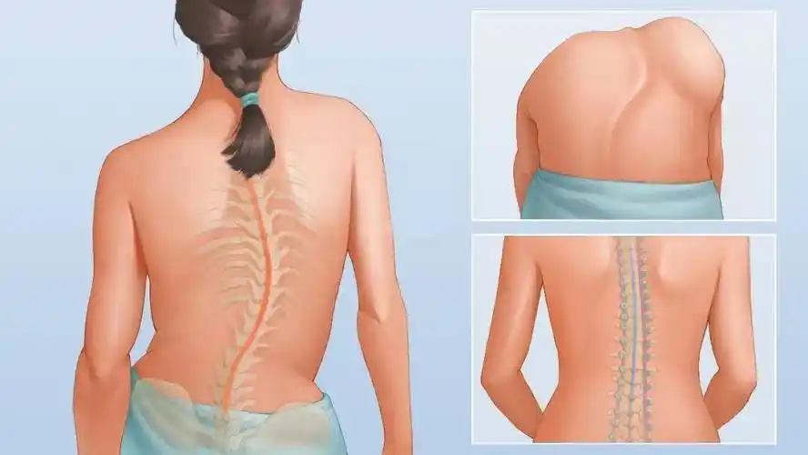 屁股沟上方有凸起,究竟是"太瘦"还是"疾病"?_肌肉_脊柱_脊椎