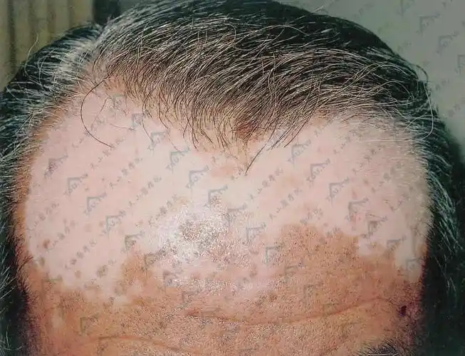 部分头发变白,前额见大片色素脱失斑