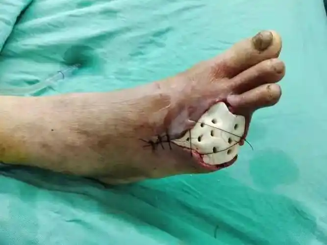 早期接受正规治疗,是可以最大限度保留肢体功能,避免高位截肢的