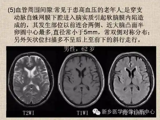 教你区分脉络膜裂囊肿蛛网膜囊肿血管间隙神经上皮囊肿还是侧脑室局部