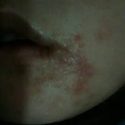 宝宝嘴角长了密密麻麻的小水泡 这边村医说用红霉素软膏 用了几天也没