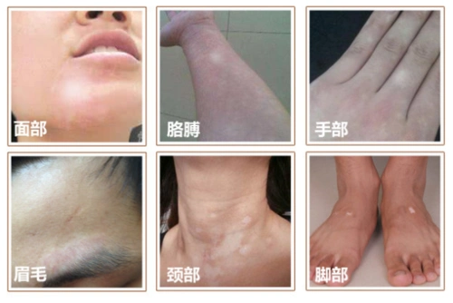 白斑鉴别,这样的才是白癜风