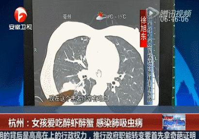 女子乳房里取出3条活虫,医生都吓一跳!罪魁祸首就是它!