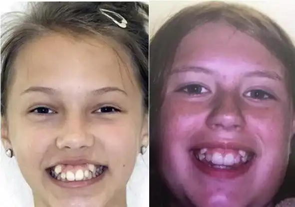 你的"虎牙"好看吗?