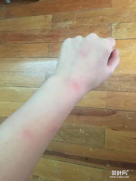 螨虫知识百科:螨虫叮咬后的症状图