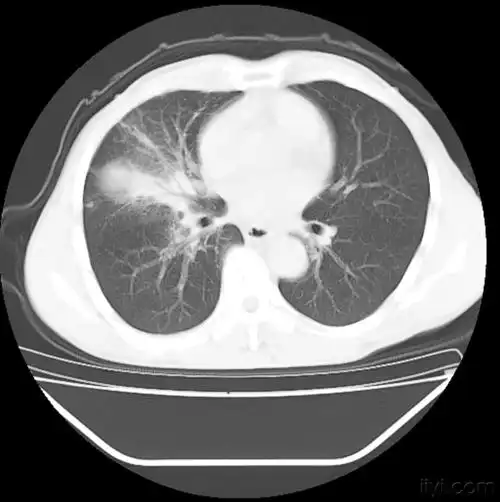 肺癌ct片