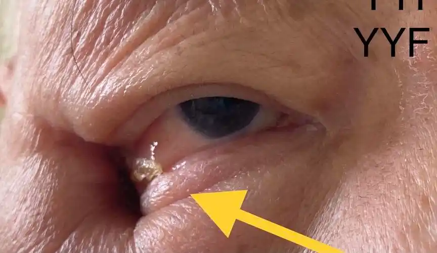 上颌窦恶性肿瘤切除术后的眼睑缺损修复&鼻眶沟通肿瘤_上颌窦癌_上颌